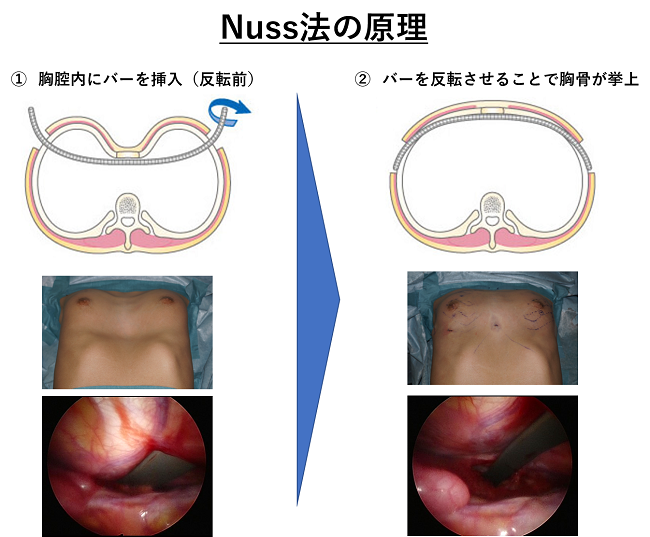 漏斗胸の治療 - その他