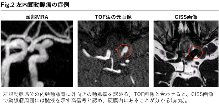 判断に迷う際は横浜労災へ～ 未破裂脳動脈瘤における診断・紹介時の 