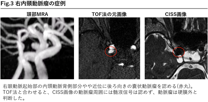 判断に迷う際は横浜労災へ～ 未破裂脳動脈瘤における診断・紹介時の 