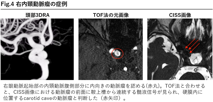 判断に迷う際は横浜労災へ~ 未破裂脳動脈瘤における診断・紹介 判断に迷う際は横浜労災へ~ 未破裂脳動脈瘤における診断・紹介