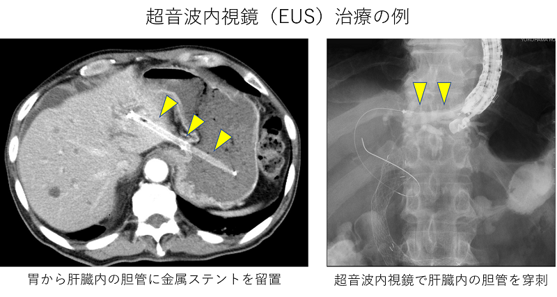 超音波内視鏡（EUS）を主軸とした胆膵疾患の早期診断・治療に力