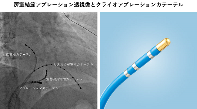 不整脈に対するカテーテルアブレーション ~アブレーション治療 不整脈に対するカテーテルアブレーション ~アブレーション治療