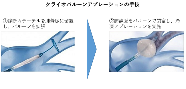 不整脈に対するカテーテルアブレーション ~アブレーション治療 不整脈に対するカテーテルアブレーション ~アブレーション治療